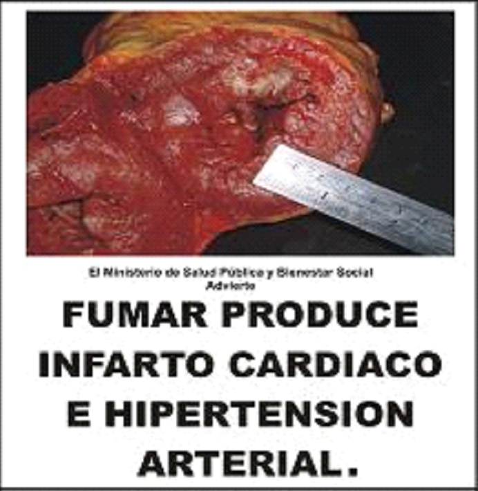 Paraguay 2009 Health Effects Arteries - cardiac infarction and arterial hypertension, diseased artery image, gross